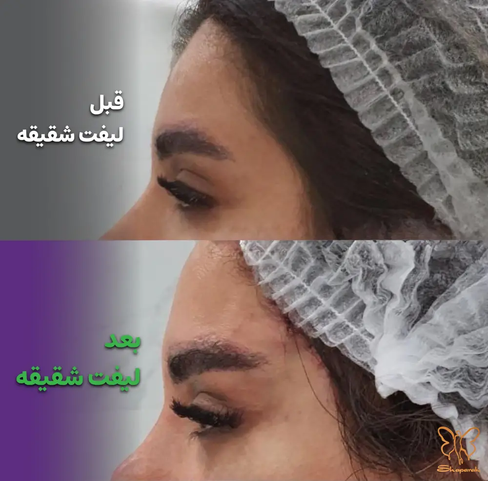 عکس قبل و بعد لیفت شقیقه در شاپرک طلایی مشهد
